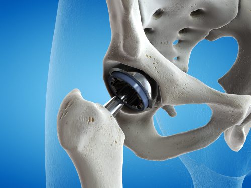 Hip Pain - 3D Rendered Illustration of a Hip Replacement