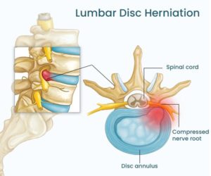 Epidural Steroid Injections treat Disc Herniations