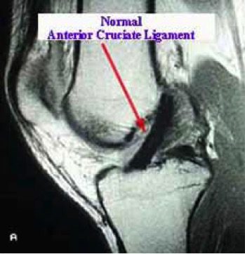 Normal ACL