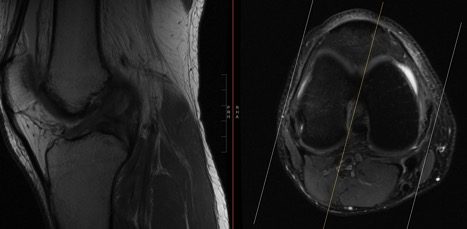 ACL Tear Repair MRI CHARM