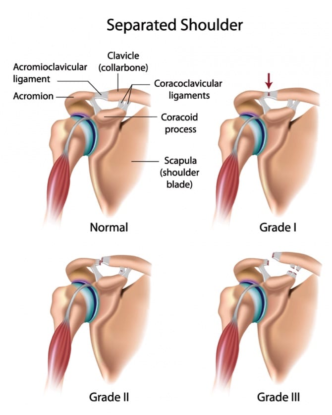 3 Grades Of Separated Shoulder: And