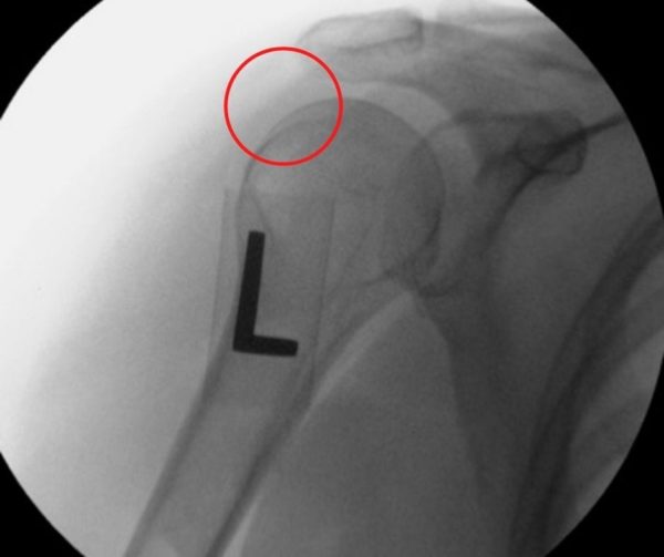 Resolution of calcification shoulder tendonitis CHARM patient