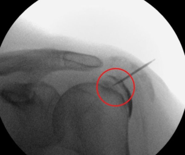 Needle entering the calcification of the right shoulder of CHARM patient under X-ray guidance