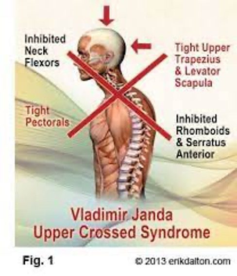 Vladimir Janda Upper Crossed Syndrome