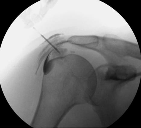 Needle placement within the calcification of CHARM patient