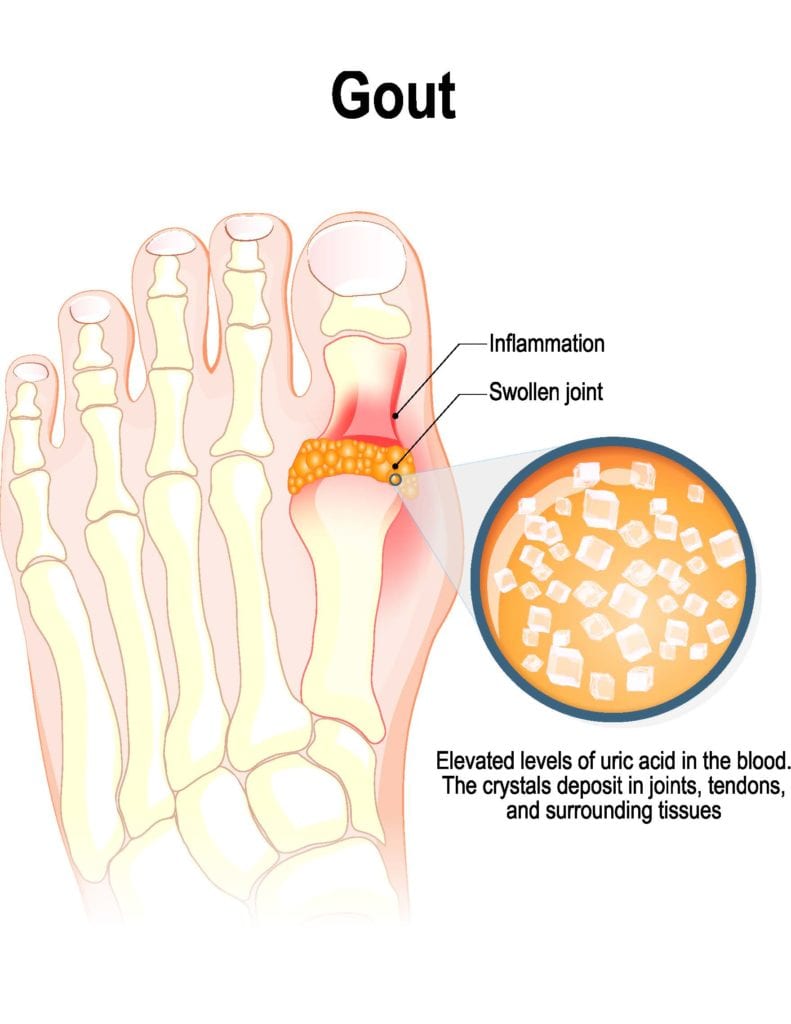 Gout Big Toe