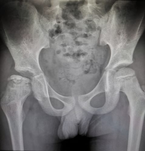 X-Ray that shows a characteristic of avascular necrosis (AVN) of femoral head