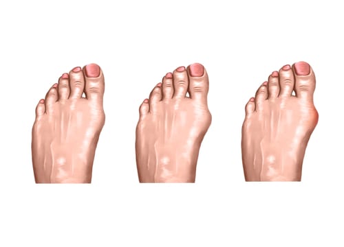 Arthritis Injuries of the foot and big toe