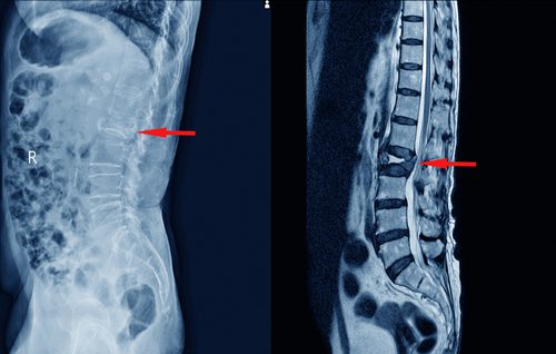 MRI showing compression fracture