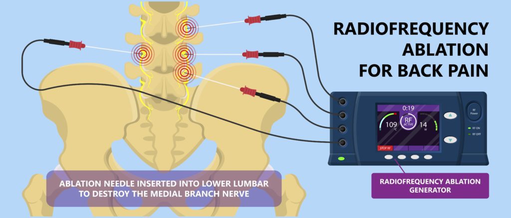 Radiofrequency Ablation for Facet Joint and Back Pain