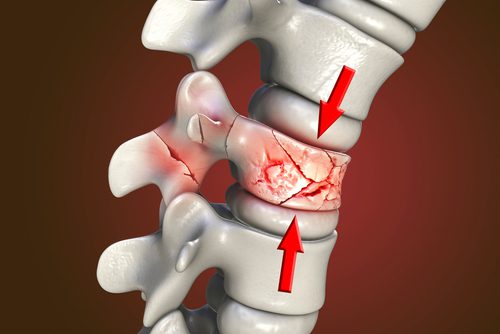3D Illustration of a spinal compression fracture