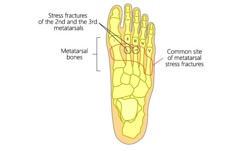 Metatarsal or Foot Stress Fracture rendering