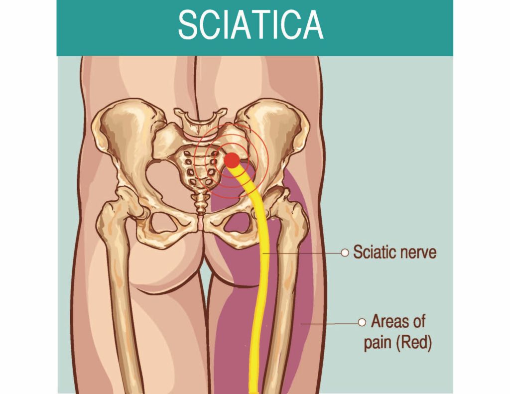 Symptoms of Sciatica Illustration